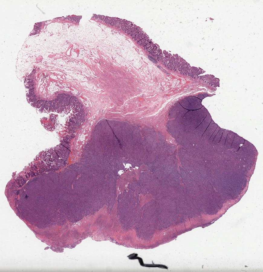 H&E tissue from the TCGA colon cancer study