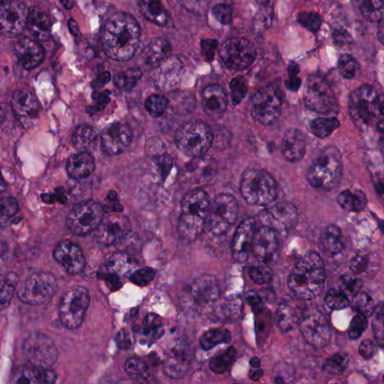 A 96-micrometer H&E region selected for high predicted neutrophil and malignant-cell content