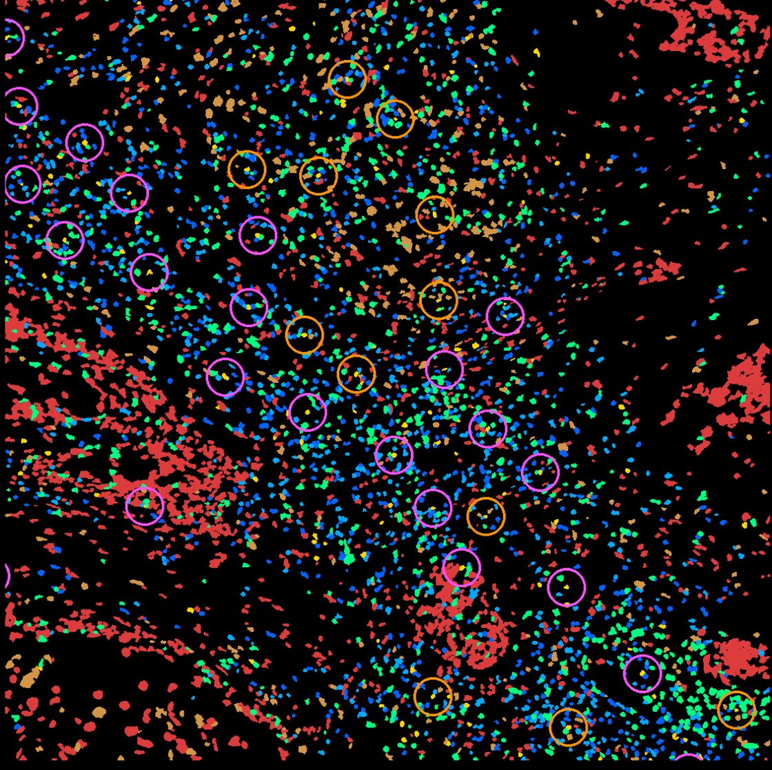 Spatial map of a cervical tumor with cells colored by MiraTyper type and circles marking CD4–CD8–dendritic-cell triads