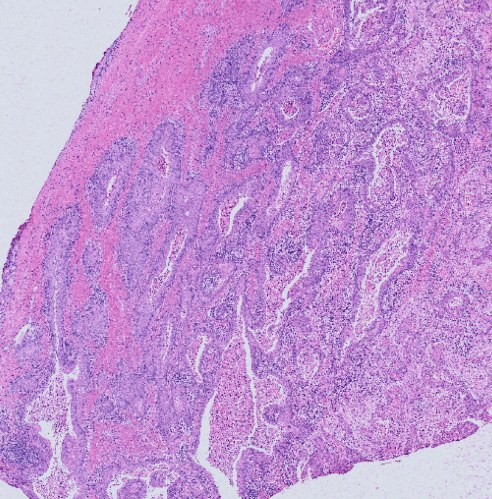 H&E section of a cervical tumor