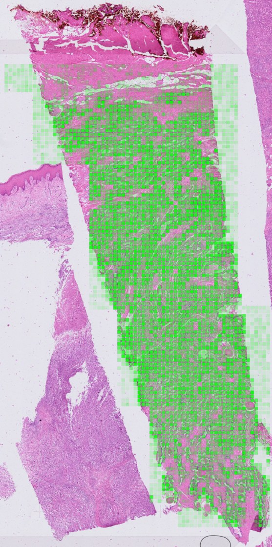 PSMA RNA expression predicted from H&E across a prostate cancer section, shown as green tiles