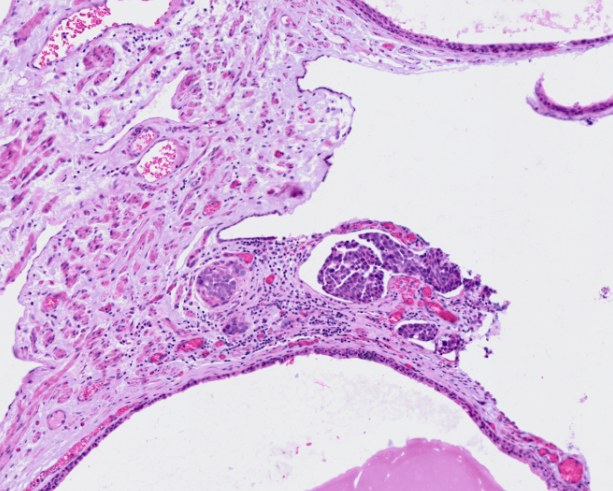 H&E of a region containing a tertiary lymphoid structure