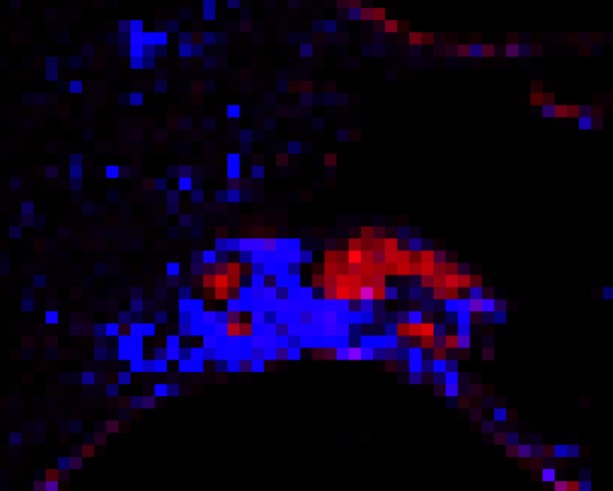 Predicted malignant cells in red and immune cells in blue